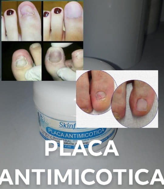 ONICOPLASTIA PODOLOGICO UÑA FORT (SOLUCION) 30ML