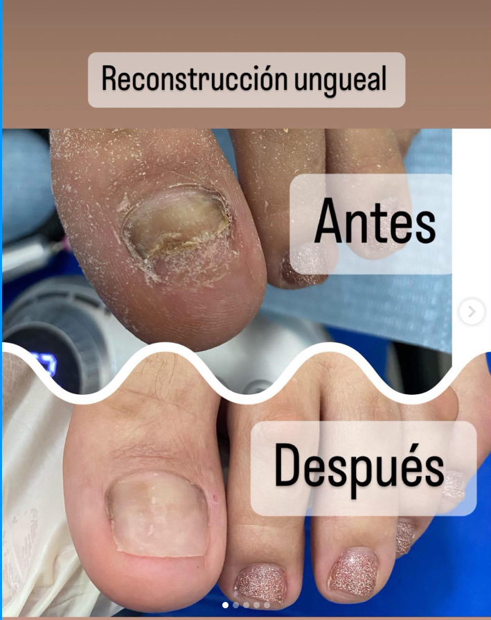 ONICOPLASTIA PODOLOGICO UÑA FORT (SOLUCION) 30ML